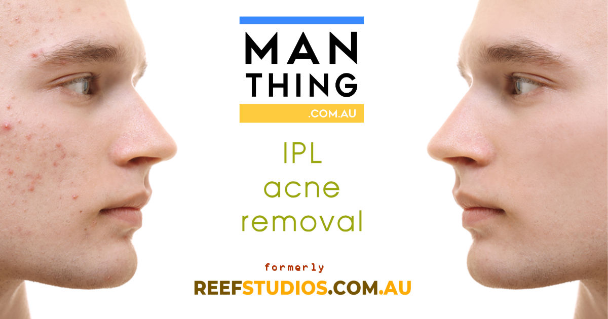 IPL Acne Removal treatments at Reef Studios Rockhampton