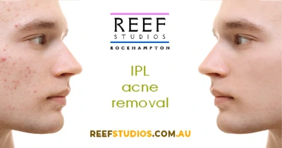 IPL acne removal treatments available at Reef Studios in Rockhampton