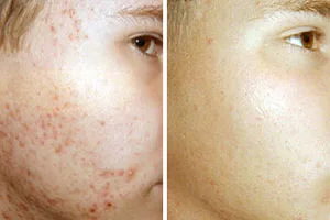 Acne IPL treatment before and after - Rockhampton