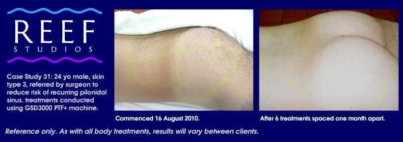 Permanent hair removal butt and genital areas for men
