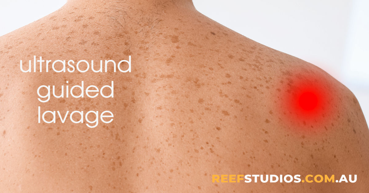 Ultrasound-guided Lavage of the Shoulder